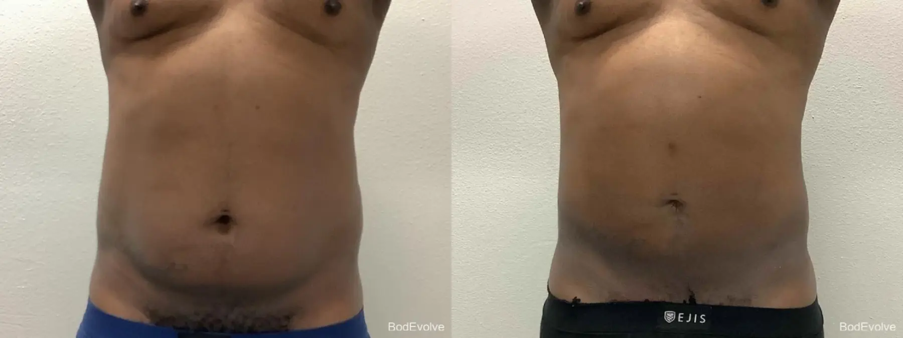 Liposuction: Patient 9 - Before and After  