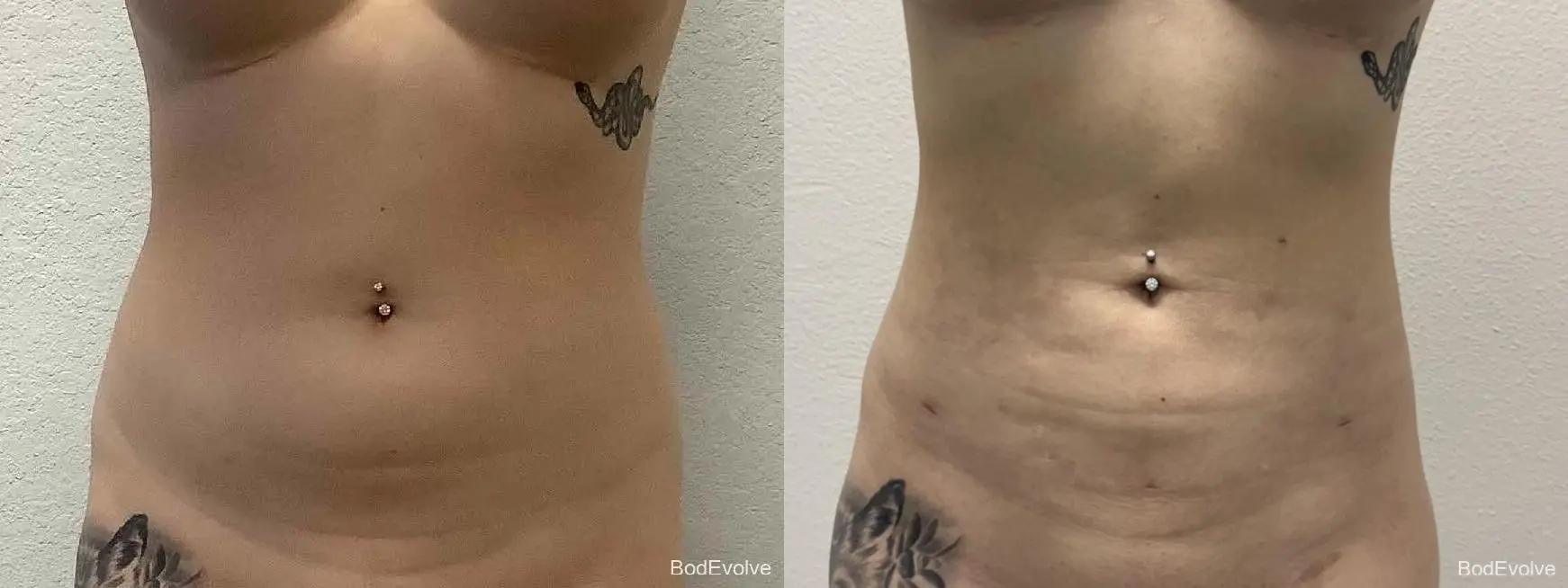 Liposuction: Patient 2 - Before and After  