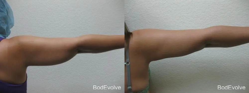 Liposuction - Patient 1 - Before and After 6