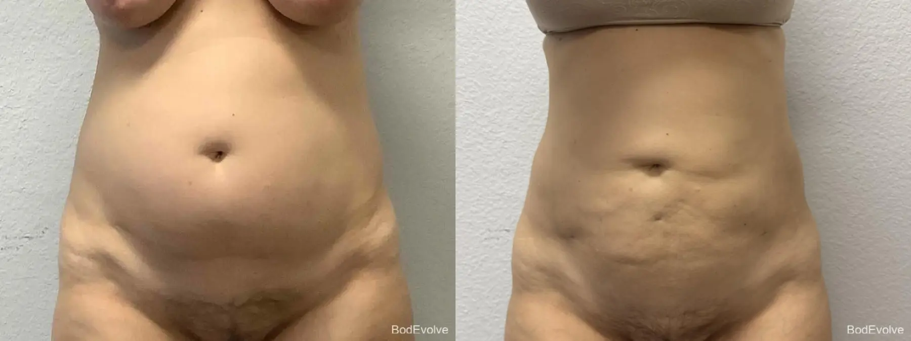 Liposuction: Patient 6 - Before and After  