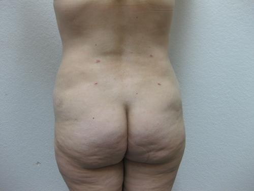 Liposuction - Patient 3 -  After 4