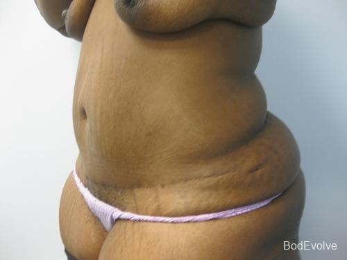 Patient 2 - Cosmetic Surgery After Massive Weight Loss -  After 2