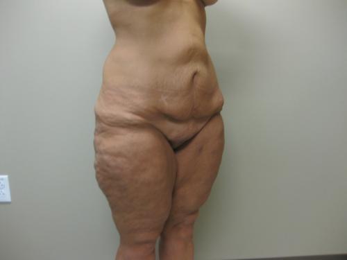 Patient 25 - Cosmetic Surgery After Massive Weight Loss - Before and After 8