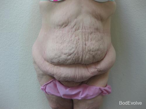 Patient 6 - Cosmetic Surgery After Massive Weight Loss - Before