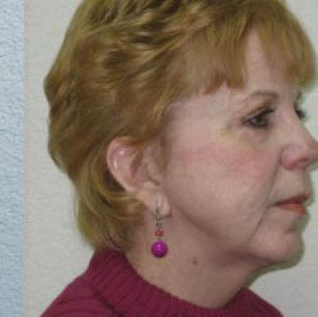 Facelift - Patient 1 - After Image 4
