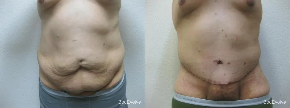 Body Lift - Patient 1 - Before and After