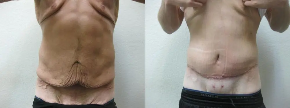 Body Lift - Patient 5 - Before and After