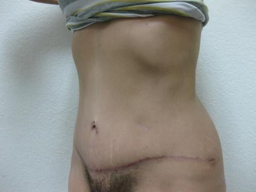 Patient 11 - Cosmetic Surgery After Massive Weight Loss -  After 2