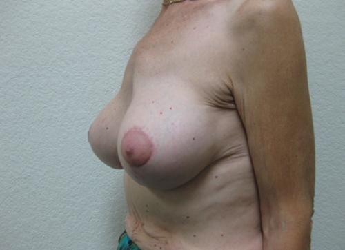Breast Augmentation with Lift - Patient 11 -  After 2