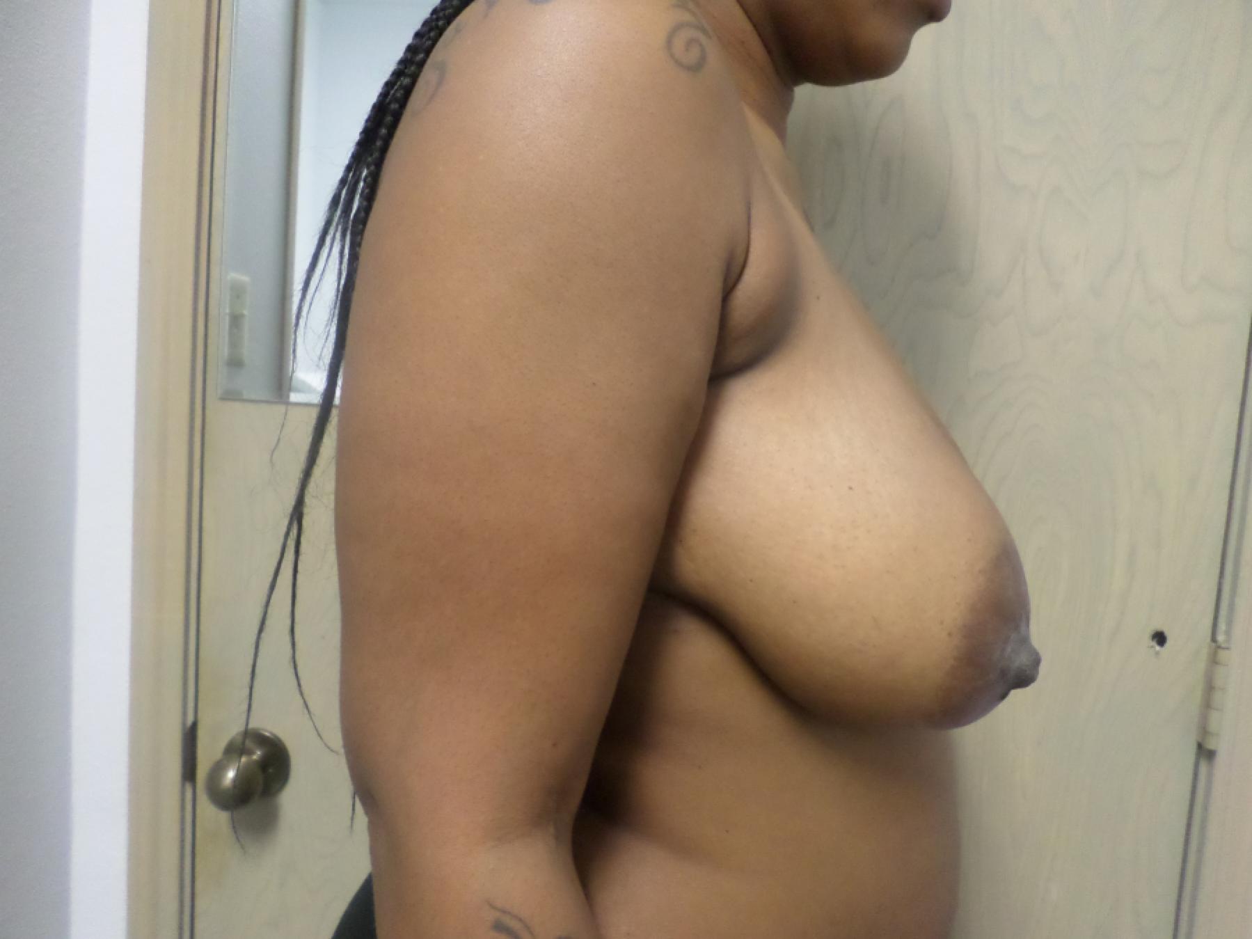 Breast Reduction: Patient 8 - Before and After 5