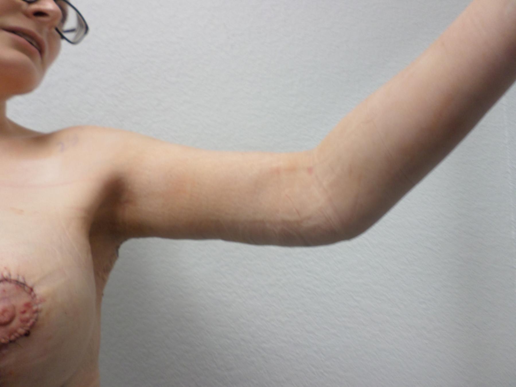 Arm Lift: Patient 8 - After 2