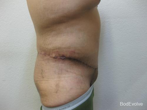 Body Lift - Patient 1 - After 7