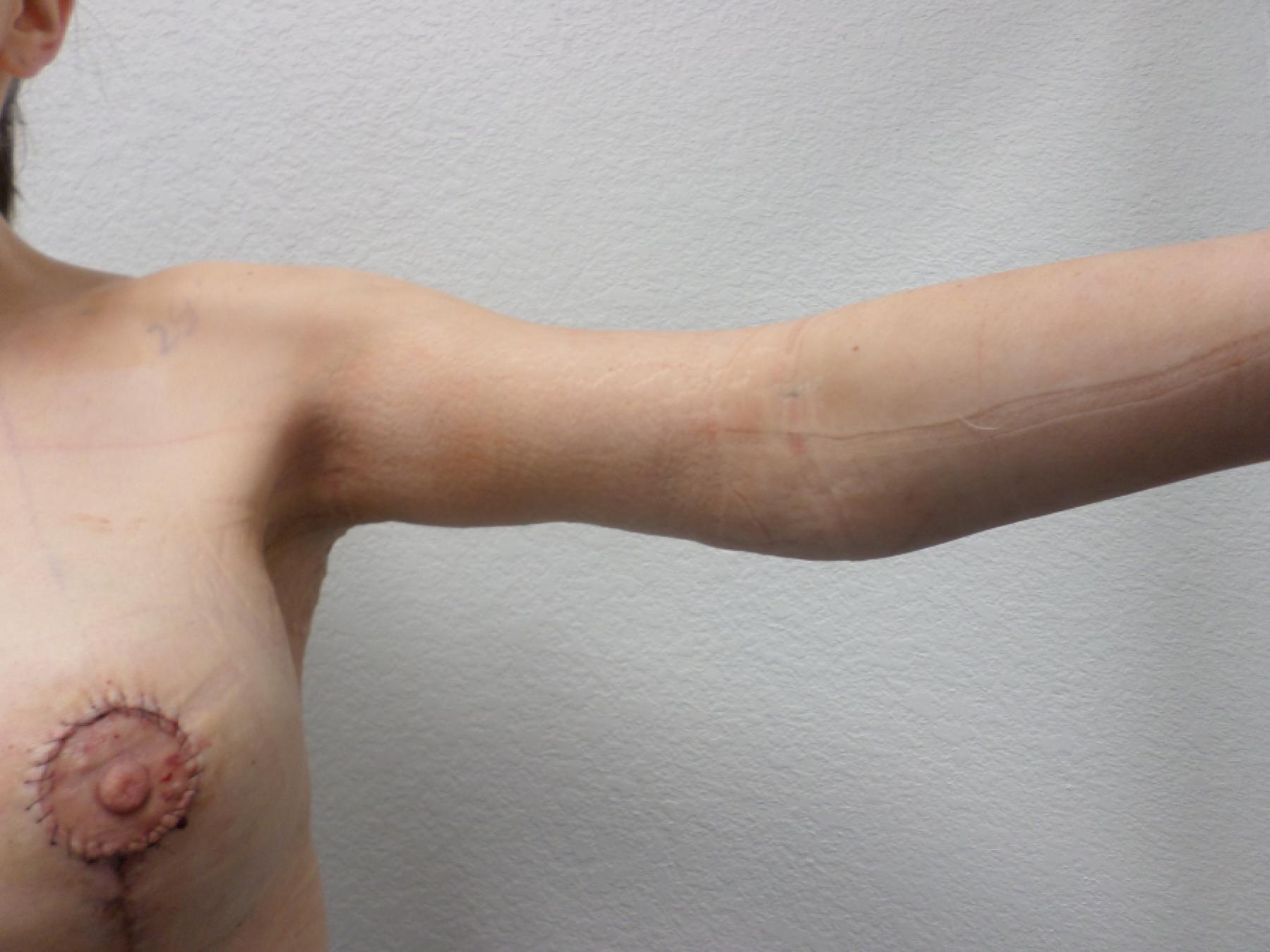 Arm Lift: Patient 4 - After  