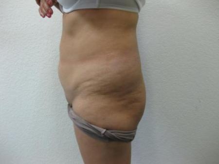 Brazilian Butt Lift - Patient 4 - Before Image 4
