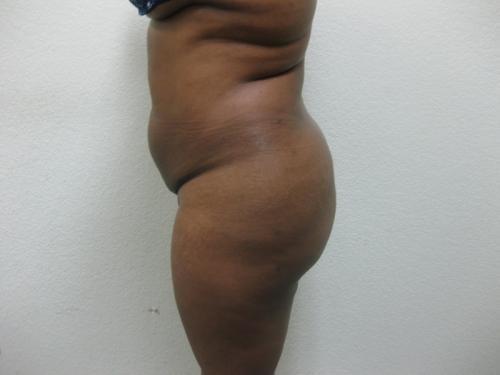 Brazilian Butt Lift - Patient 5 - After 2