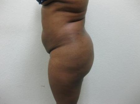 Brazilian Butt Lift - Patient 5 - After Image 2