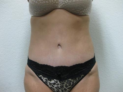 Tummy Tuck - Patient 4 -  After 2