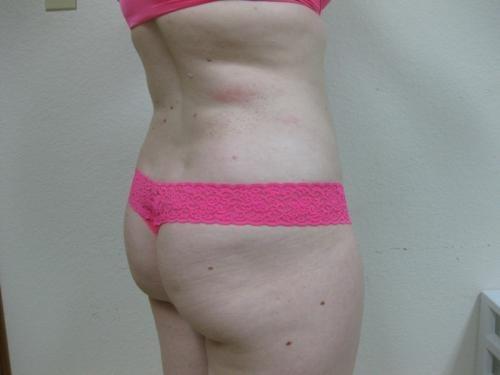Liposuction - Patient 5 -  After 3