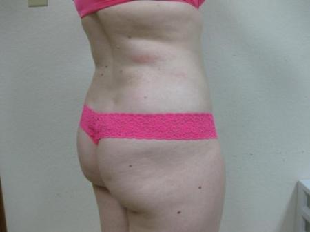 Liposuction - Patient 5 - After Image 3