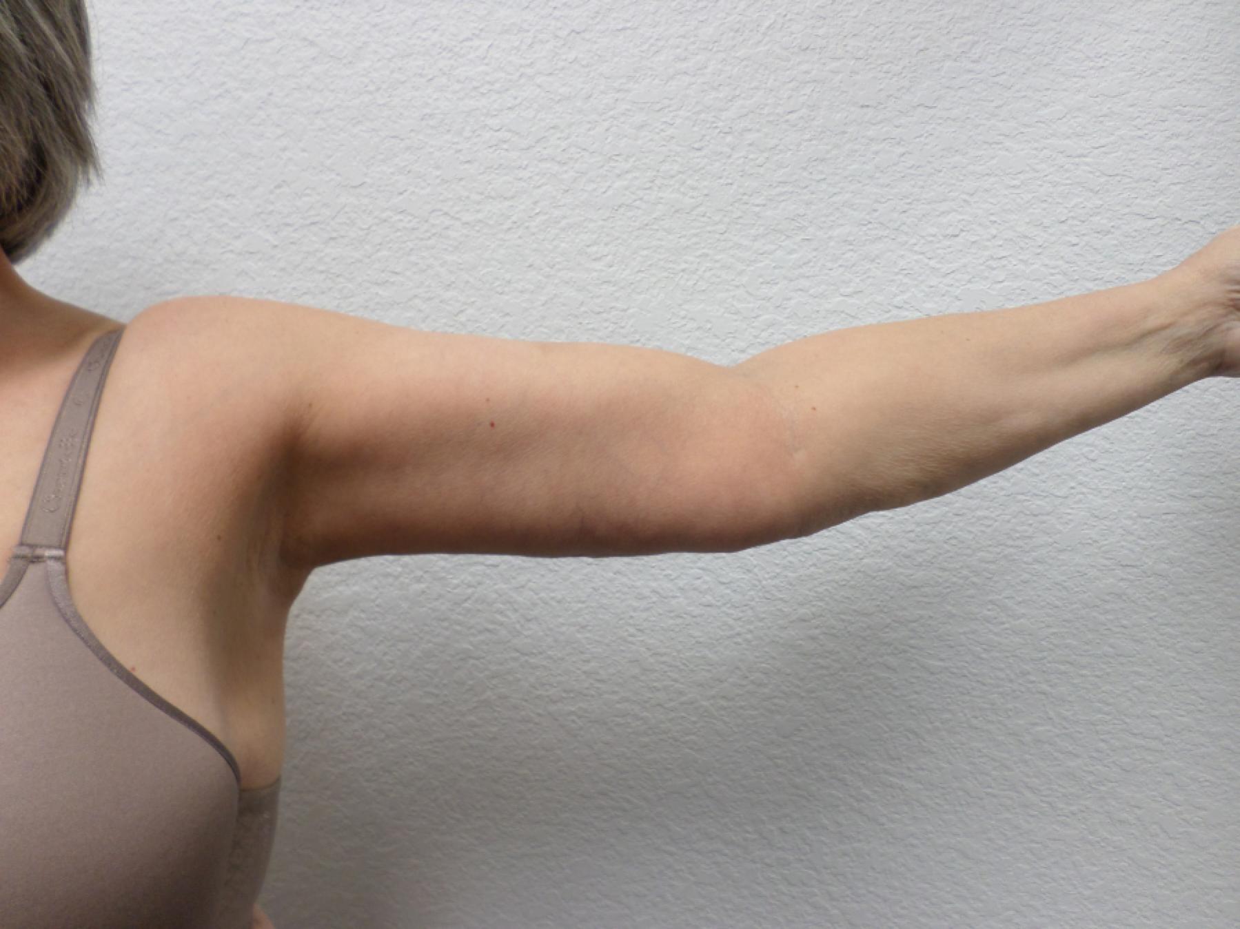 Arm Lift: Patient 9 - After 2