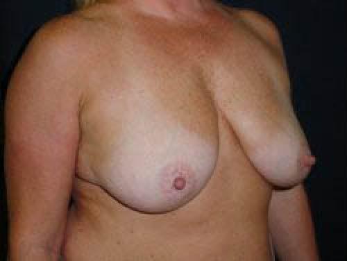 Breast Augmentation with Lift - Patient 6 - Before 2