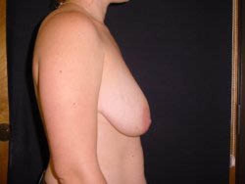 Breast Augmentation with Lift - Patient 5 - Before and After 3