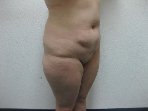 Liposuction - Patient 3 - Before and After 7