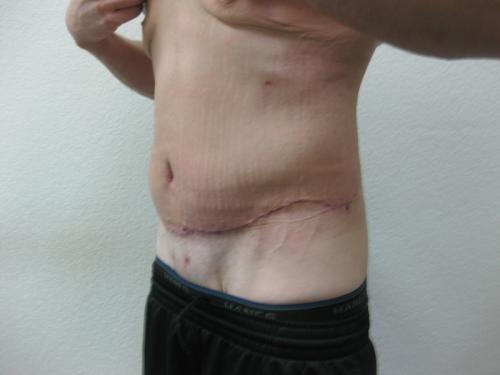 Body Lift - Patient 5 - After 2
