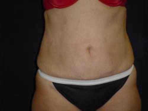 Liposuction - Patient 10 -  After 1