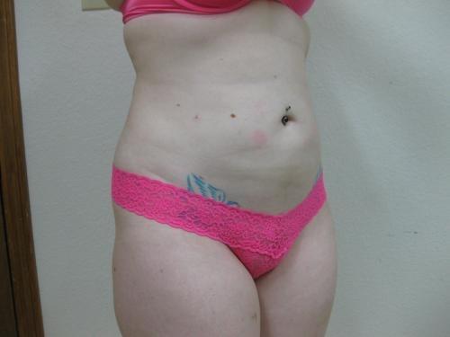 Liposuction - Patient 5 -  After 7