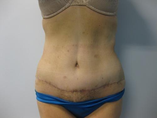 Patient 15 - Cosmetic Surgery After Massive Weight Loss -  After 1