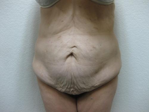 Patient 15 - Cosmetic Surgery After Massive Weight Loss - Before 1