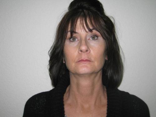 Lip Augmentation - Patient 2 - Before