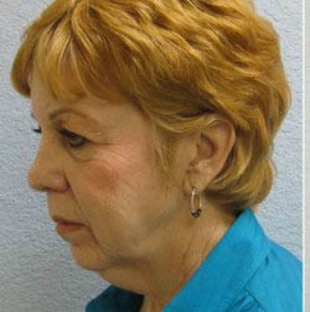Facelift - Patient 1 - Before Image 2