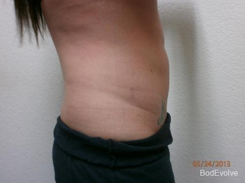 Liposuction - Patient 2 -  After 5