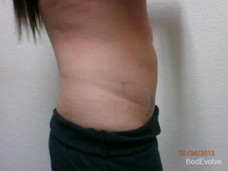 Liposuction - Patient 2 - After Image 5