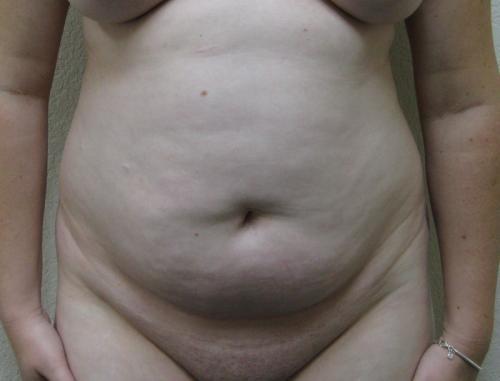 Tummy Tuck - Patient 15 - Before 1