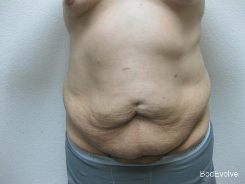 Patient 3 - Cosmetic Surgery After Massive Weight Loss - Before