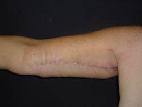 Arm Lift Surgery - Patient 2 -  After 2