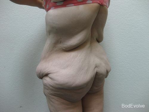 Body Lift - Patient 3 - Before 5