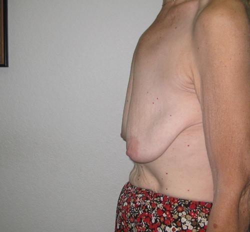 Breast Augmentation with Lift - Patient 11 - Before and After 3