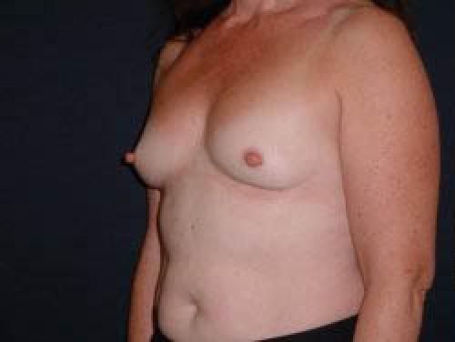 Breast Augmentation - Patient 9 - Before 2