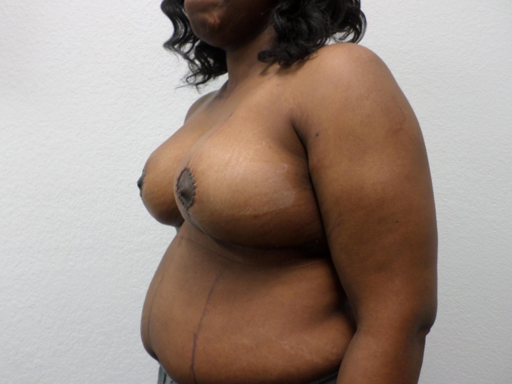 Breast Reduction: Patient 14 - After 2