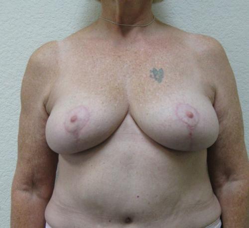 Breast Reduction - Patient 4 -  After 1