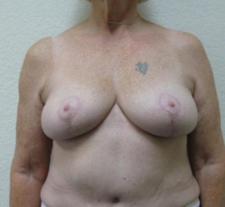 Breast Reduction - Patient 4 - After 