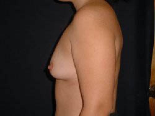 Breast Augmentation - Patient 8 - Before and After 3