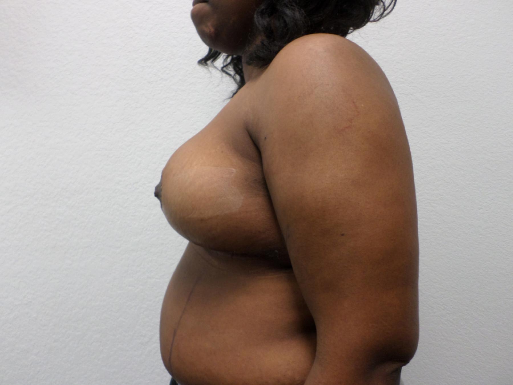 Breast Reduction: Patient 14 - After 3