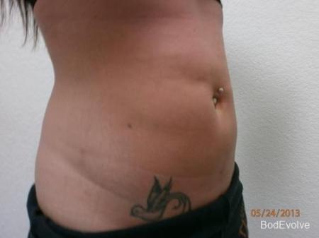 Liposuction - Patient 2 - After Image 4