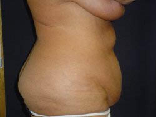 Liposuction - Patient 11 - Before and After 3