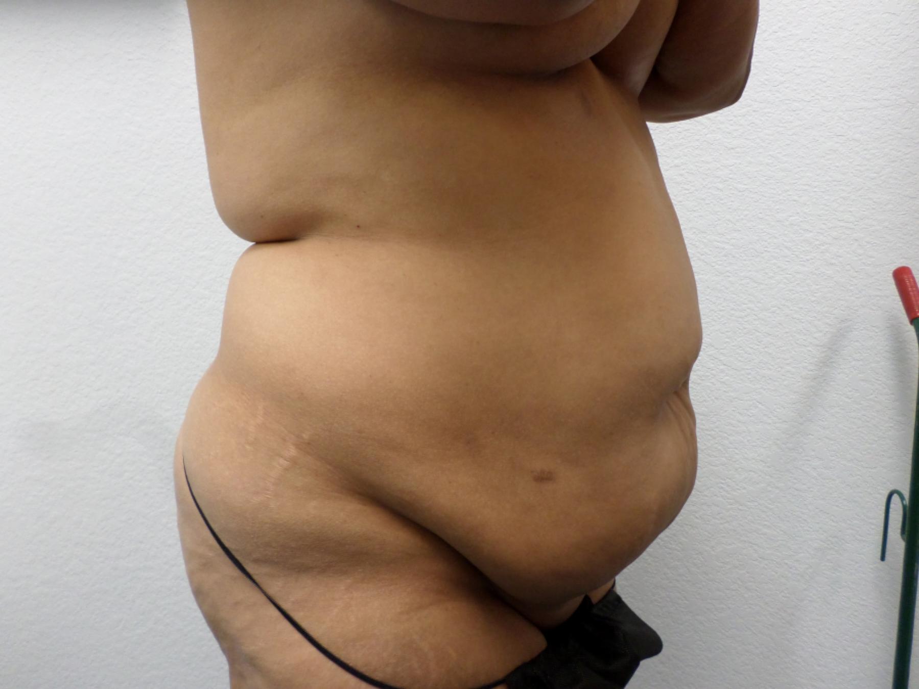 Liposuction: Patient 16 - Before 4